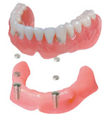 オーバーデンチャー