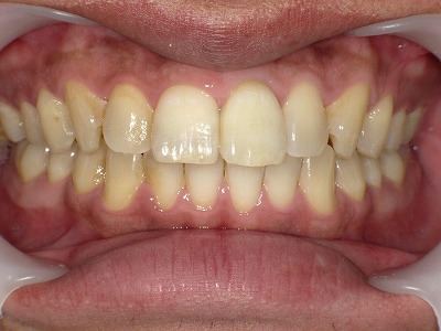 ウォーキングブリーチ後