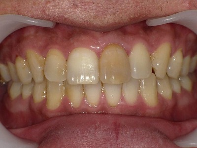 ウォーキングブリーチ前