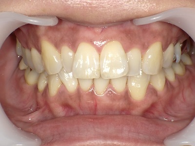 歯肉漂白後