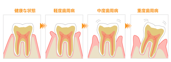歯周病の進行